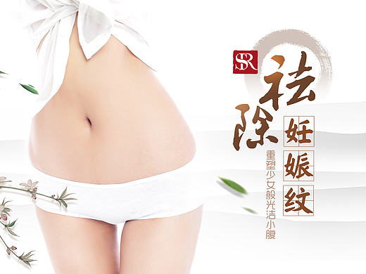 美容整形—妊娠纹