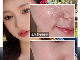 医美案例