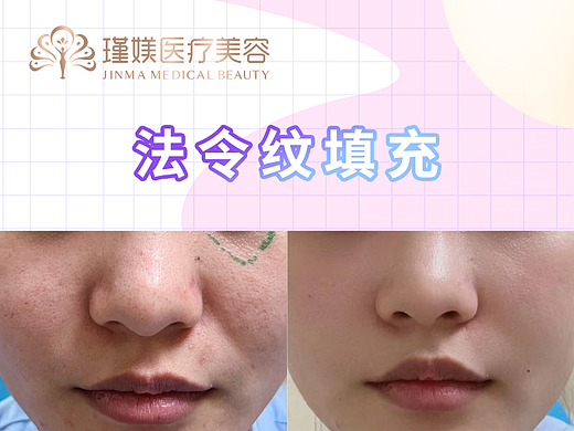 医美案例效果对比视频