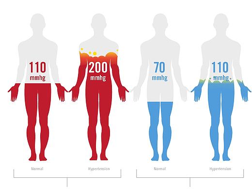 高血压的起因和后果（信息设计） 