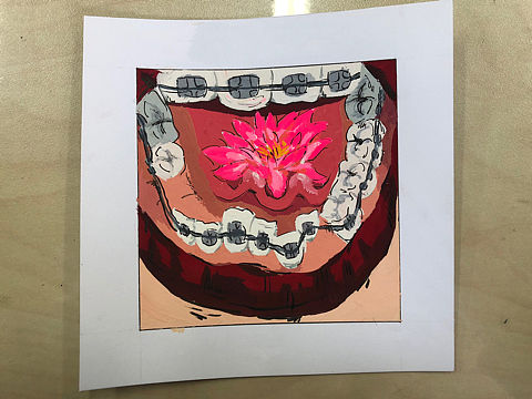 牙套