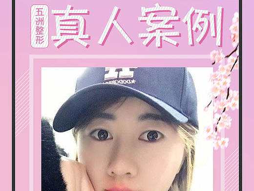 整形 案例