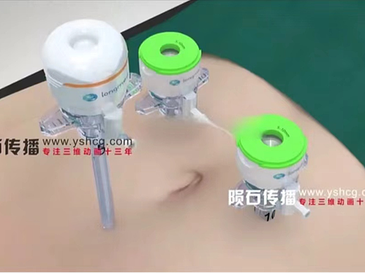 腹腔穿刺手术动画 医疗手术3D动画