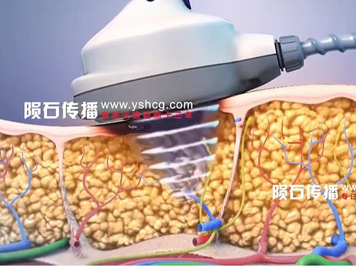 脂肪溶解手术三维动画精彩展示，快来看看吧！