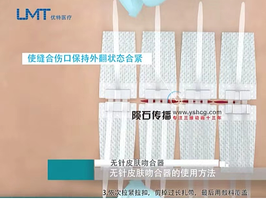 皮肤缝合器3D动画使用方法解说