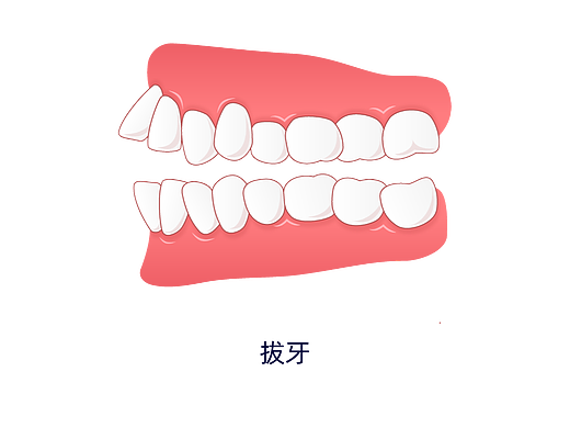 牙齿矫正过程