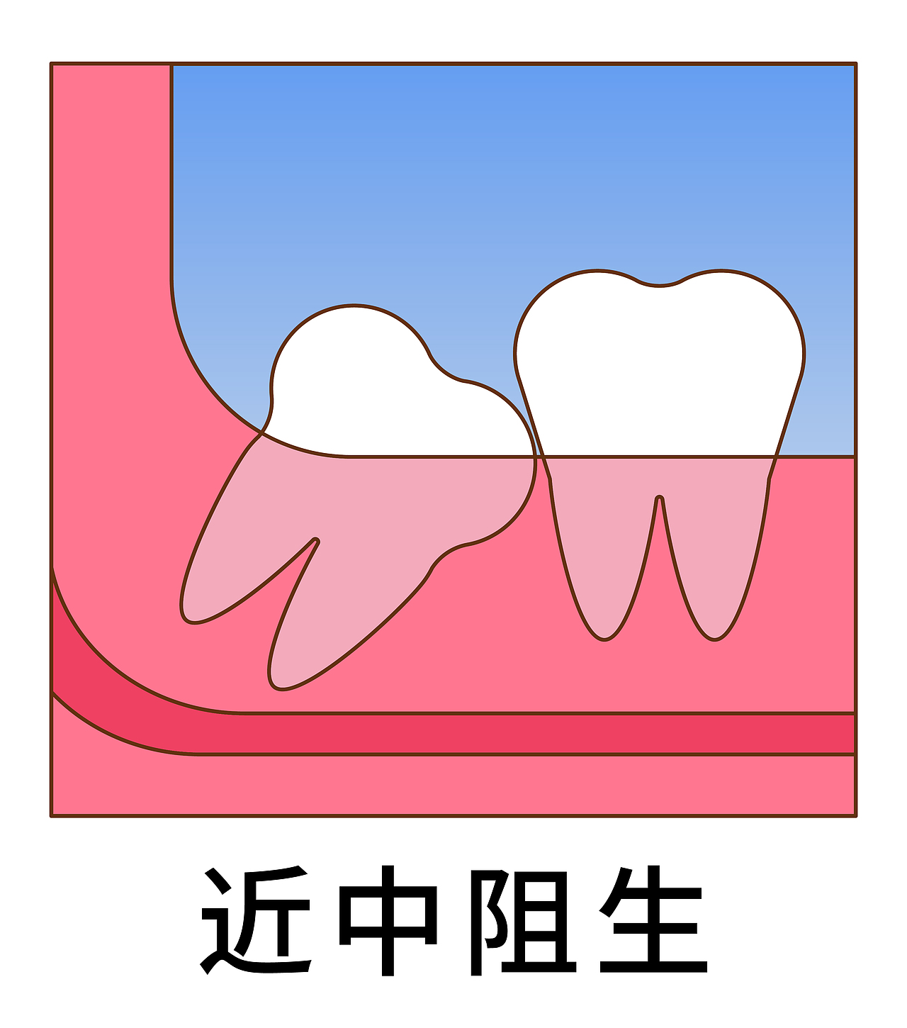 医美 口腔 牙齿插画 智齿 阻生齿类型
