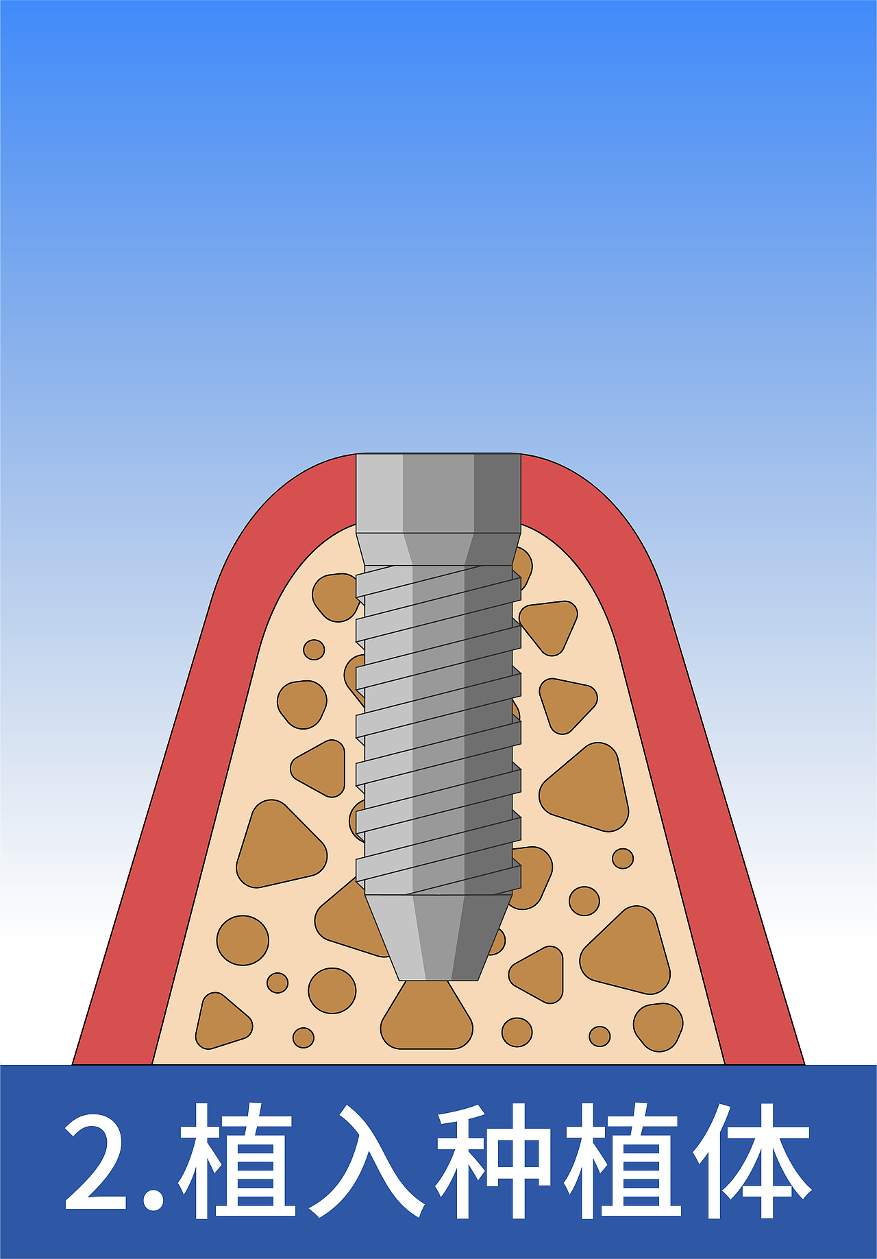 2植入种植体