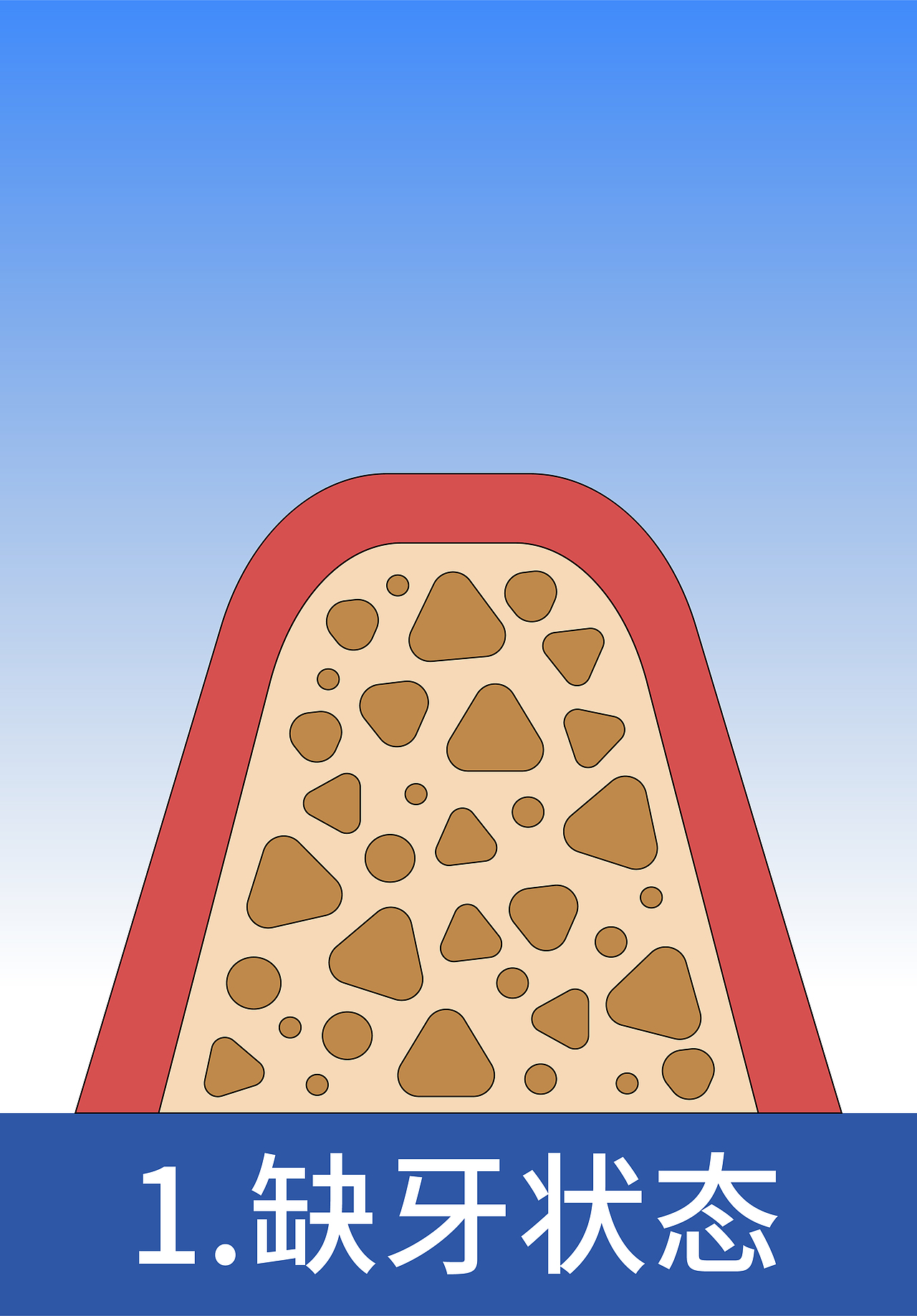 1缺牙状态