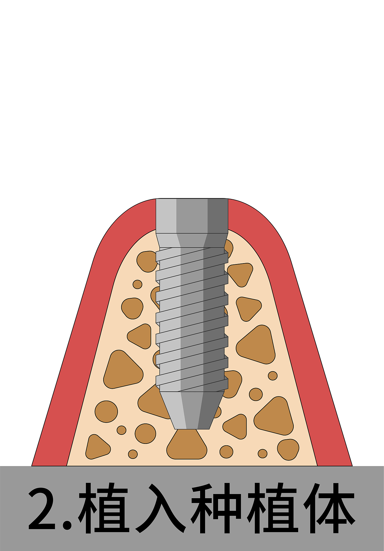医美 口腔 牙齿插画 种牙 种植牙四部曲