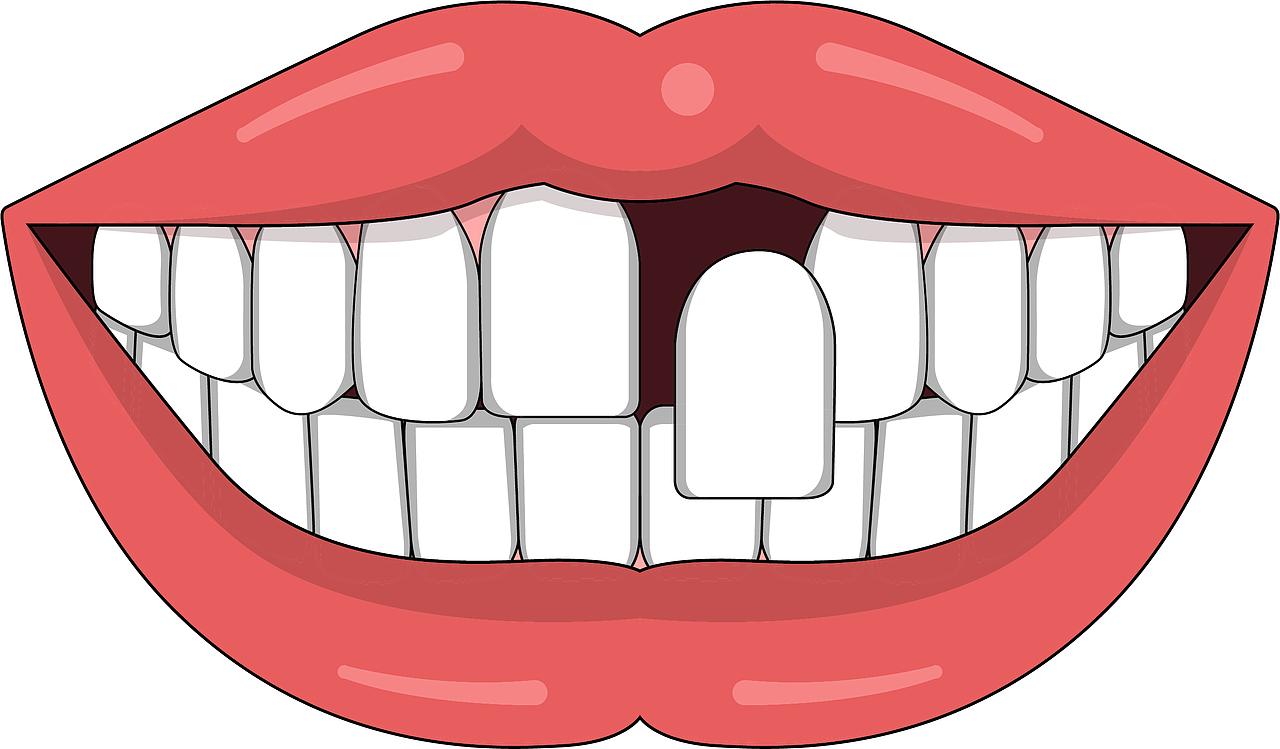 口腔 牙齿插画 种植牙 牙齿类型 牙齿缺失