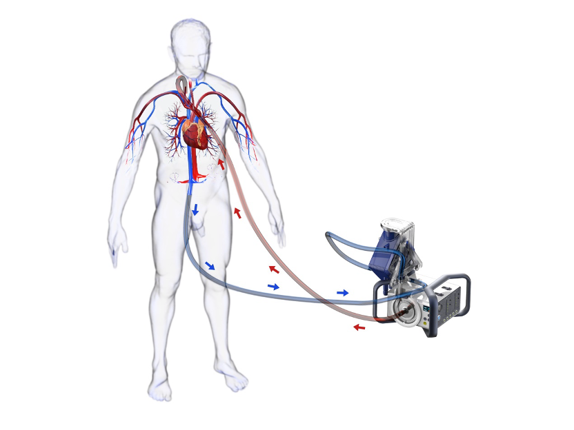 mini-ecmo