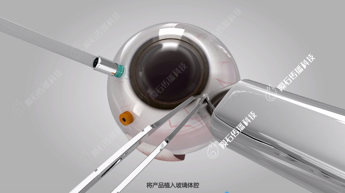 外科手術(shù)3D動(dòng)畫：精準(zhǔn)呈現(xiàn)，助力醫(yī)療新篇章（圖ZMTQ5NTUyMzY=） - 教程 - 站酷設(shè)計(jì)師隕石傳播3D單單原創(chuàng)素材 - 站酷ZCOOL