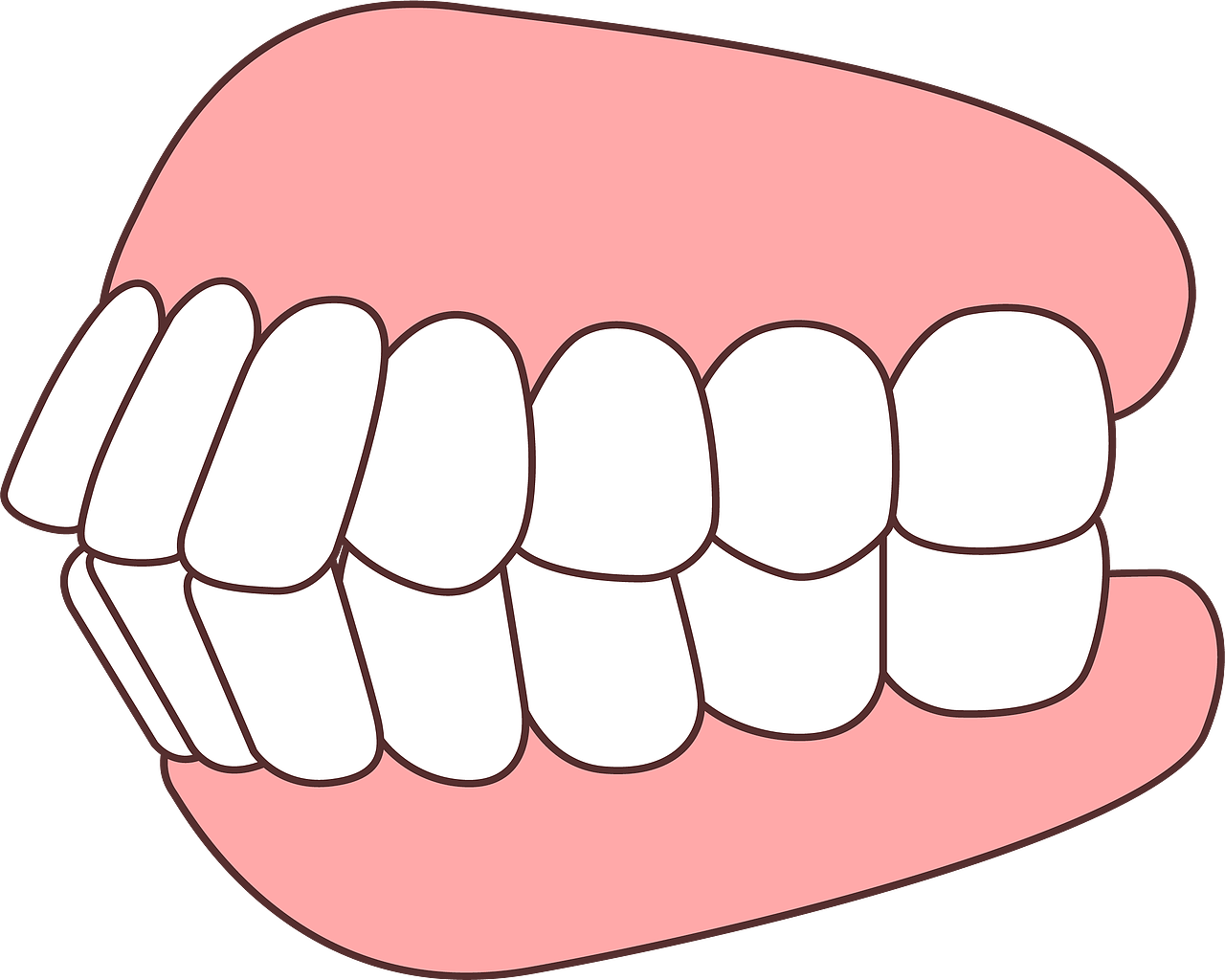 上下颌前突-骨性