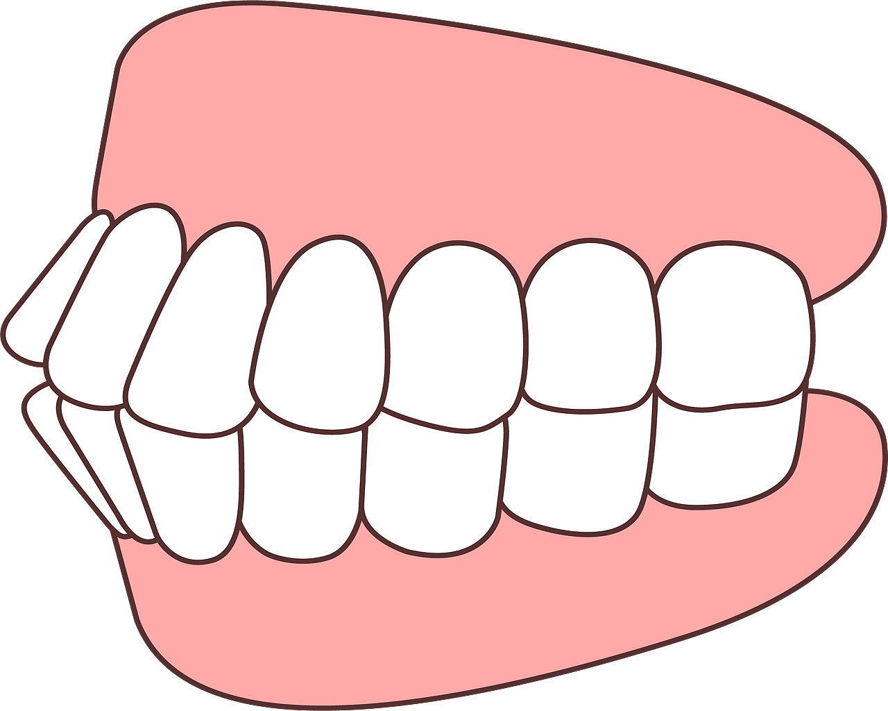 上下颌前突-牙性