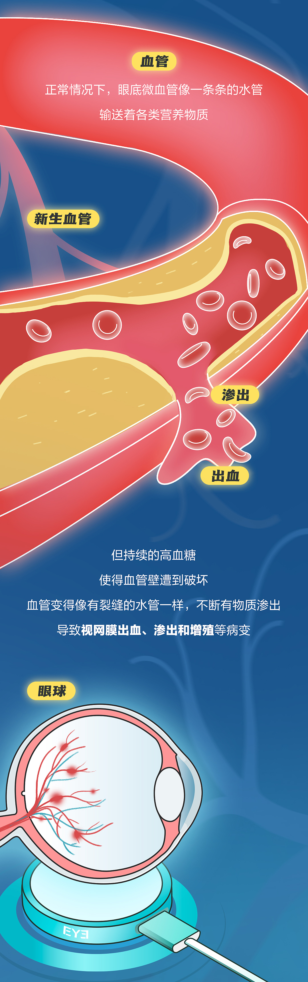 爱尔眼科糖尿病视网膜病变手绘科普长图（图ZMzgzNDUxNTQw） - 商业插画 - 站酷设计师melodudu原创素材 - 站酷ZCOOL