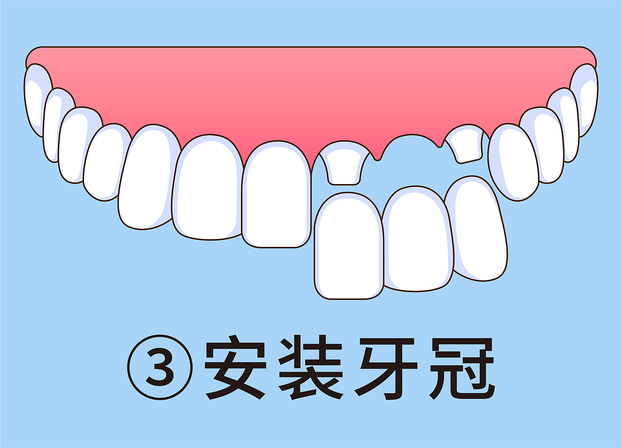 口腔 牙齿插画 牙冠四部曲(蓝色背景)