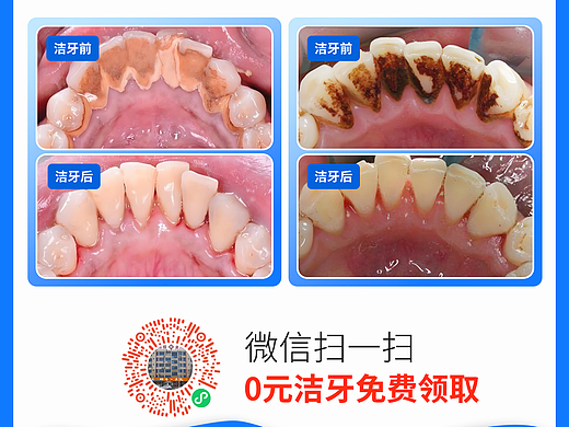 洁牙广告设计（朋友圈发圈图片）