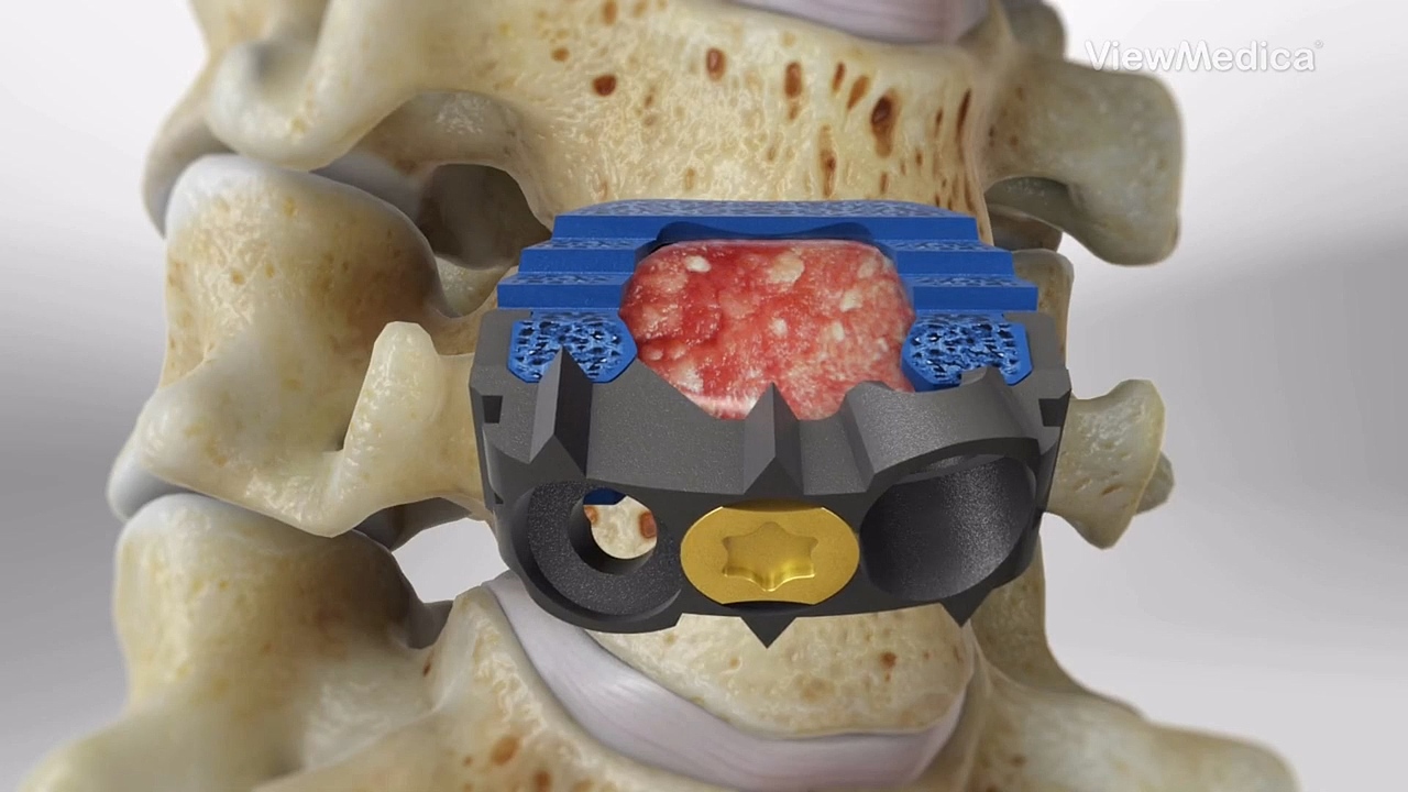 颈椎前路切除术【医疗3D动画】-医疗动画制作公司