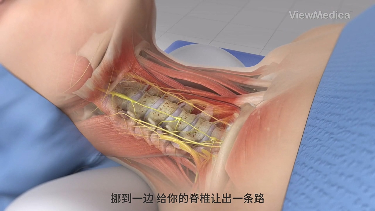 颈椎前路切除术【医疗3D动画】-医疗动画制作公司
