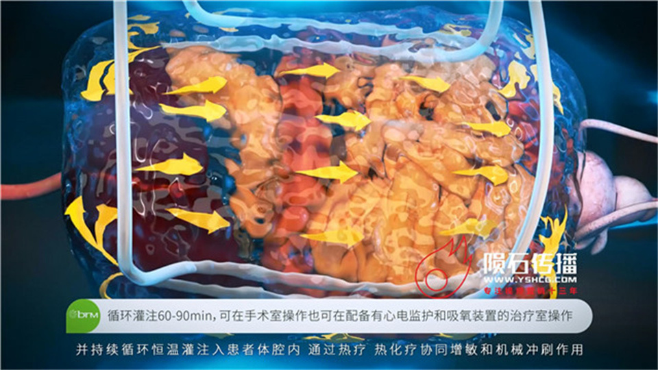 医疗动画让 ICU 设备原理不再高深莫测