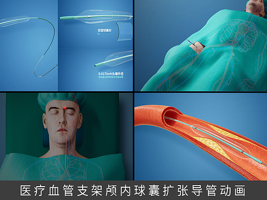 医疗血管支架颅内球囊扩张导管动画