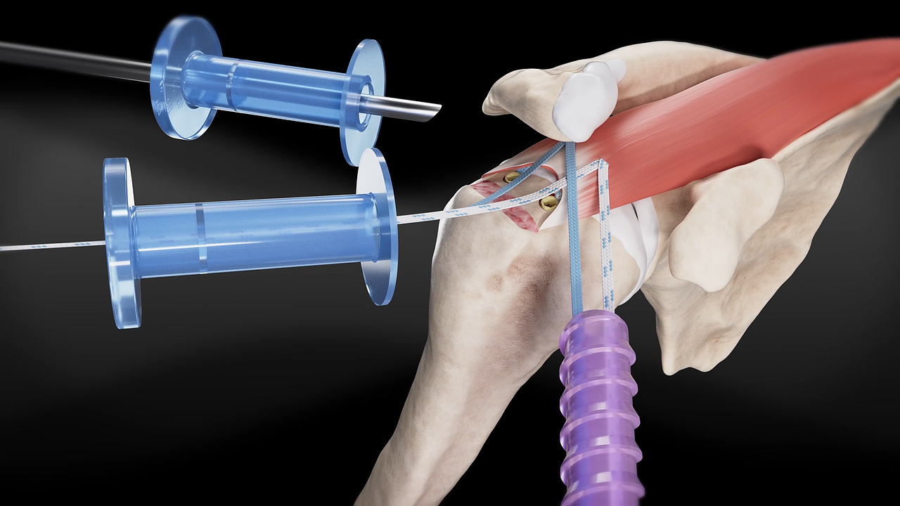 肩袖缝合手术设备操作展示动画（图ZMzk1NDA0MDgw） - 人物/生物 - 站酷设计师BRAIN不云文化原创素材 - 站酷ZCOOL