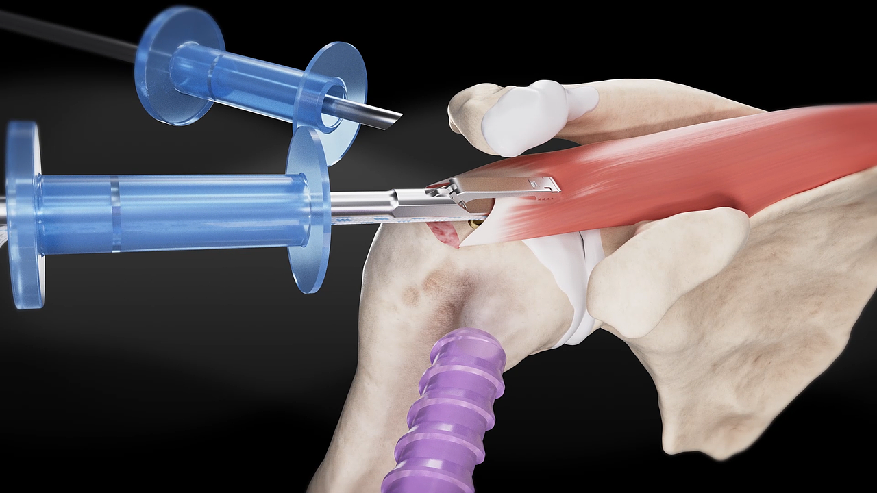 肩袖缝合手术设备操作展示动画（图ZMzk1NDA0MTQw） - 人物/生物 - 站酷设计师BRAIN不云文化原创素材 - 站酷ZCOOL