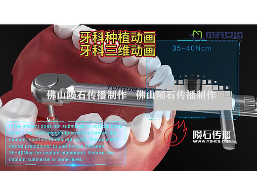 一分钟 get 种牙关键！牙科种植三维动画精简科普