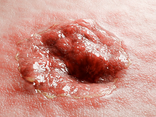 blender 伤口愈合练习 三维渲染