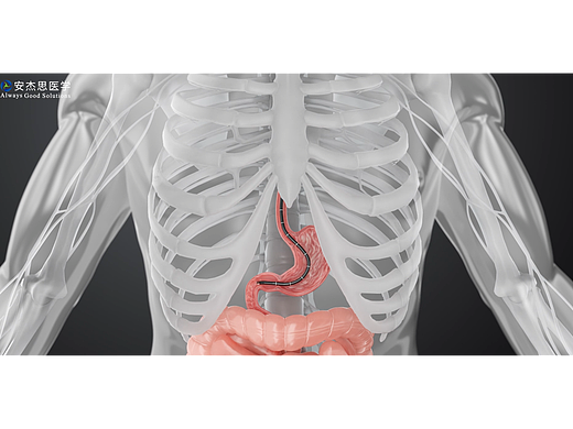 结石医疗产品切开刀手术