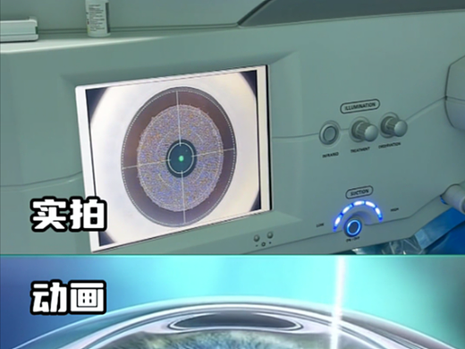 带你沉浸式体验全飞秒手术全过程