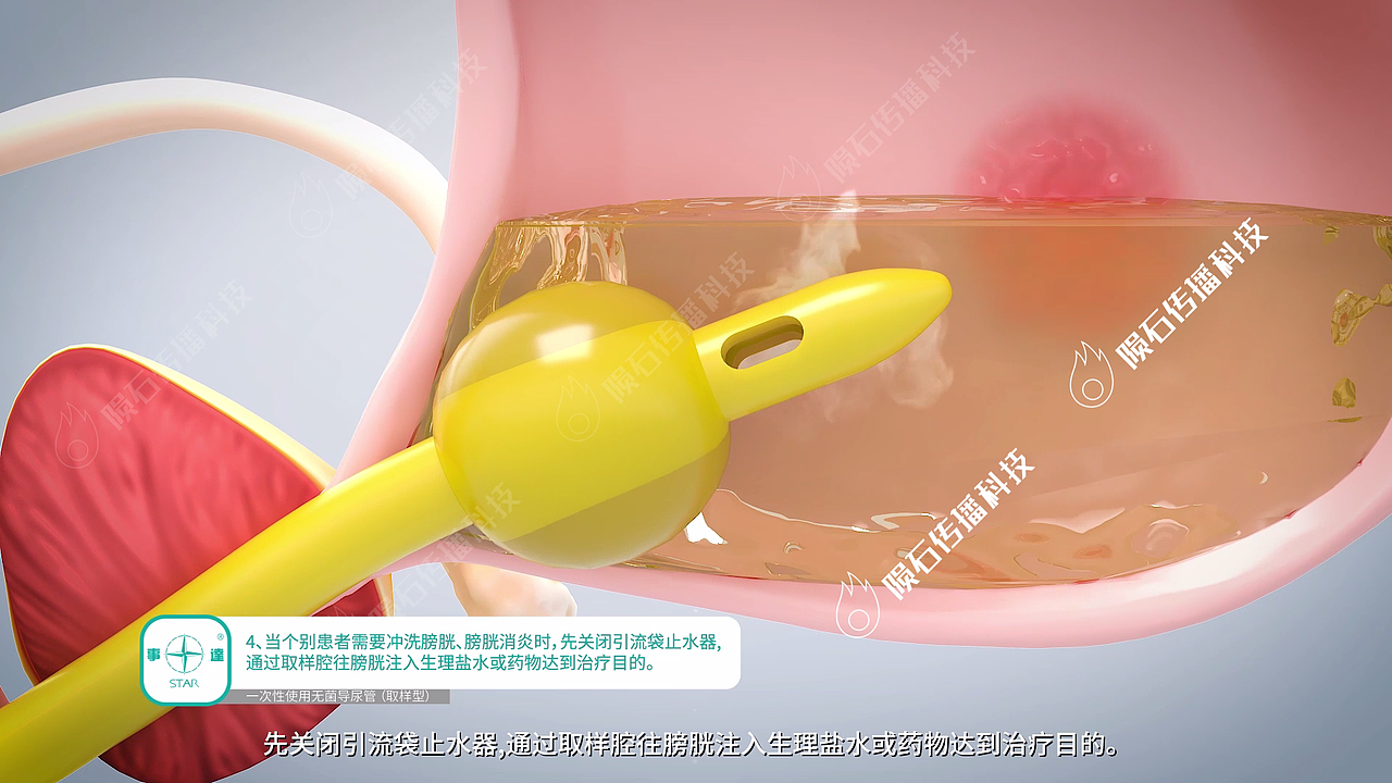 超立体深圳医疗动画，拆解各类医疗技术（图ZNDA2MTMyOTQ0） - 动画片 - 站酷设计师陨石三维动画阿容原创素材 - 站酷ZCOOL