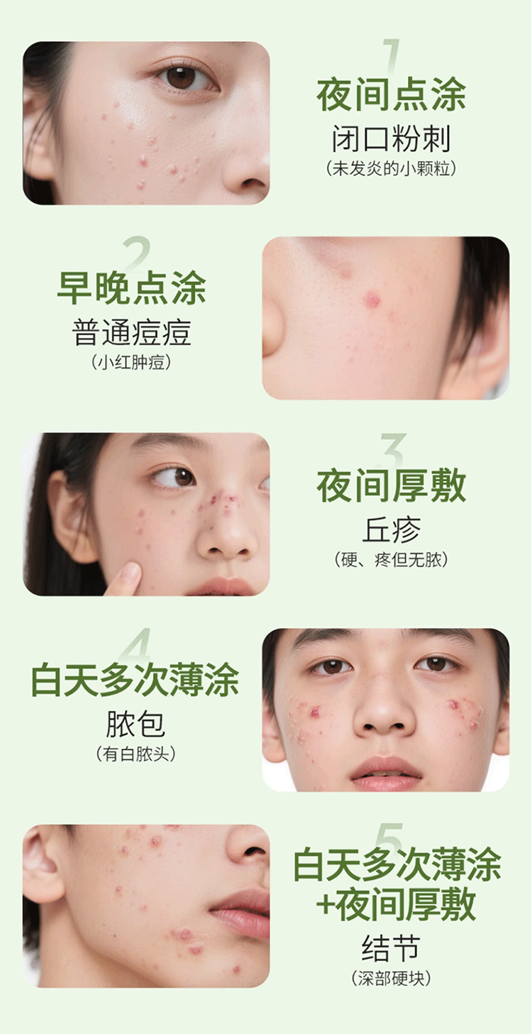 全网销量300多万的祛痘凝胶详情页是怎么样的呢?(图ZNDA5NDE0NDU2) - 电商 - 站酷设计师姚天辰原创素材 - 站酷ZCOOL